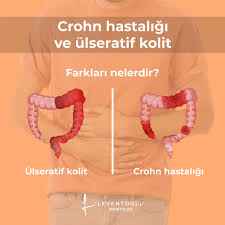 İnflamatuvar Barsak Hastalıkları Ülseratif Kolin ve Crohn Hastalığı